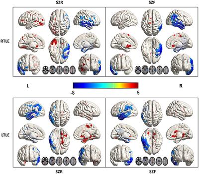 FDG-PET Profiles of Extratemporal Metabolism as a Predictor of Surgical Failure in Temporal Lobe Epilepsy